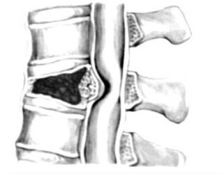 Spinal cord compression