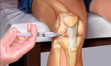 Hyaluronic acid with osteoarthritis of the knee joint