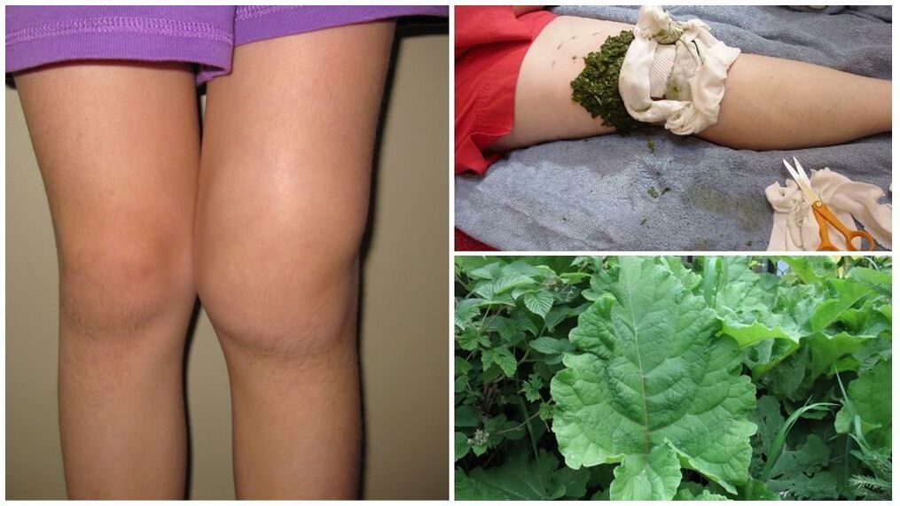 Compressing the knee with burdock a popular method for treating gonarthrosis