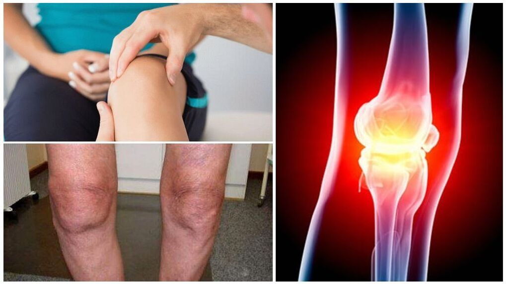 Symptoms of osteoarthritis of the knee joint.