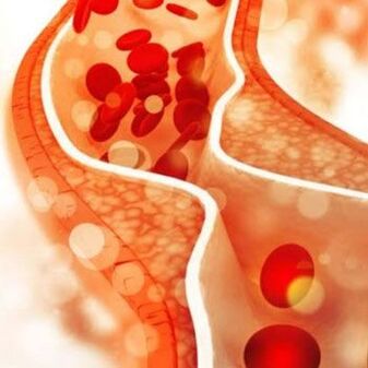 Cholesterol deposits on the inner walls of blood vessels cause pain in the side of the neck.