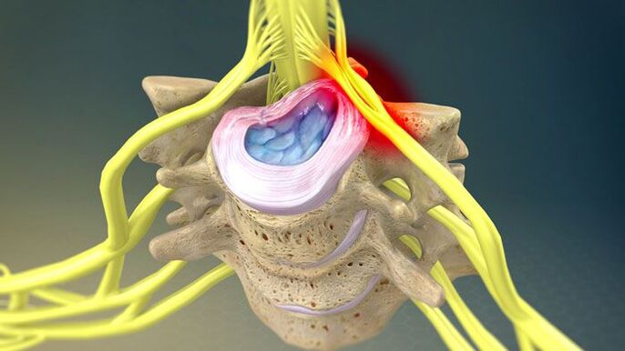 Intervertebral disc protrusion causes neck pain